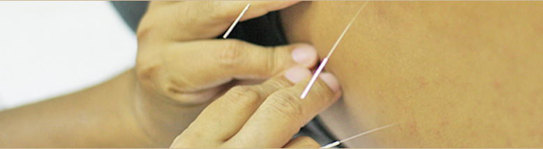鍼灸について  